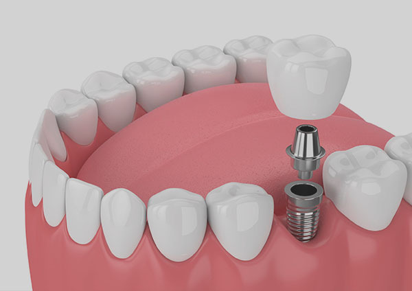 single tooth dental implants in red deer